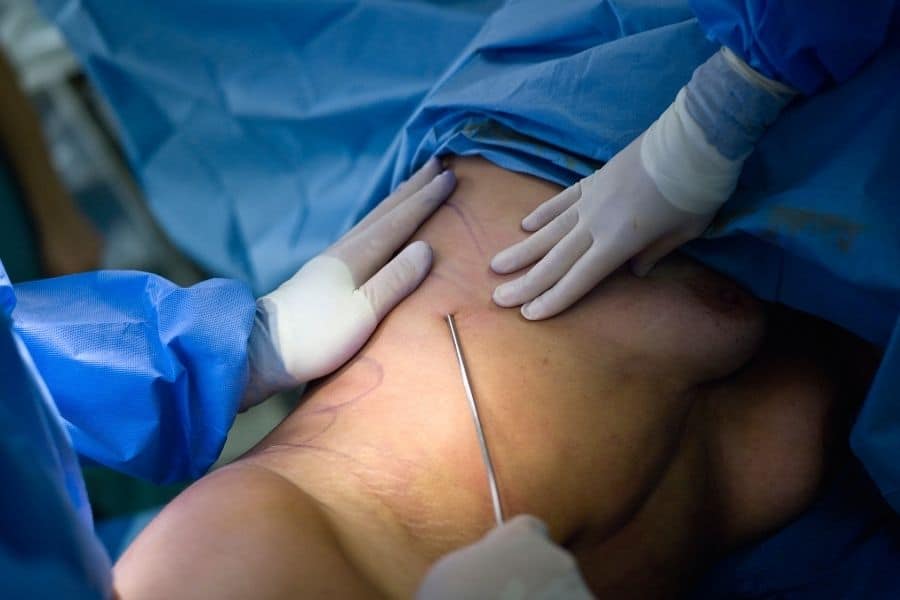 Vaser Liposuction Yağ Aldırma Uygulaması Nasıl Gerçekleşir?